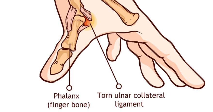 Skier’s Thumb - Plymouth Bay Orthopedic Associates, Inc.