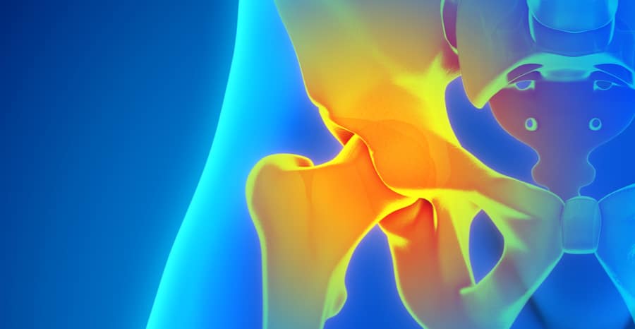 Hip Labrum Repair - Plymouth Bay Orthopedic Associates, Inc.