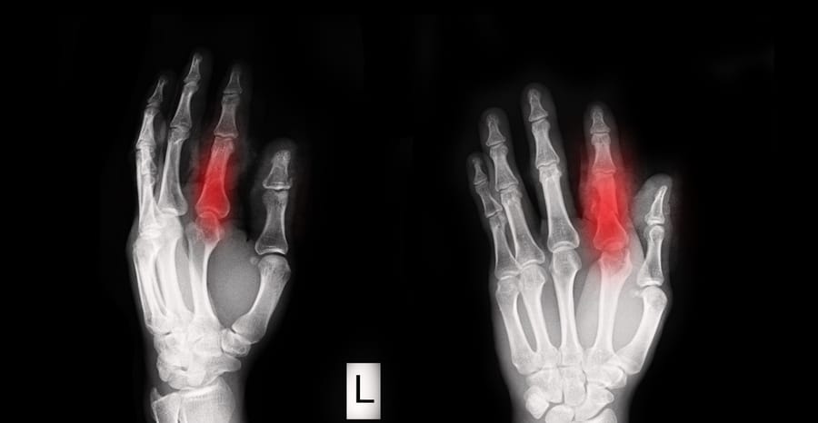 icd10 fracture of finger