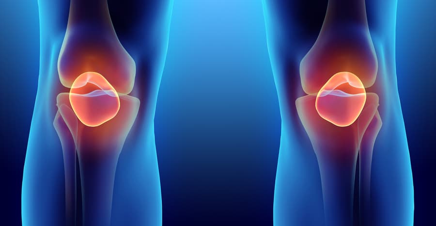 patella dislocation icd 10